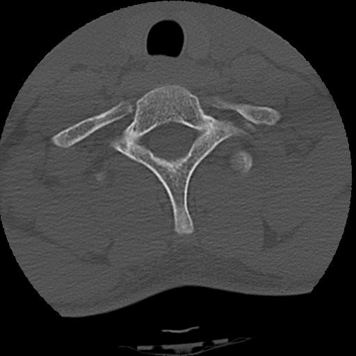 Apical pneumothorax on cervical spine CT (Radiopaedia 45343-49368 Axial bone window 77).jpg