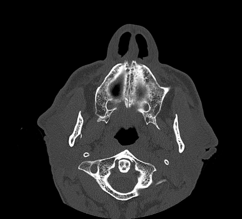 Aplastic maxillary sinuses (Radiopaedia 60030-67561 Axial non-contrast 13).jpg