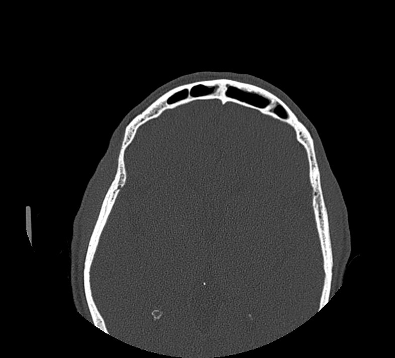 Aplastic maxillary sinuses (Radiopaedia 60030-67561 Axial non-contrast 68).jpg