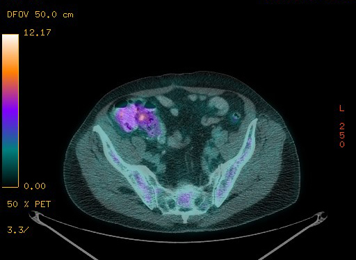 Appendiceal adenocarcinoma complicated by retroperitoneal abscess (Radiopaedia 58007-65041 Axial PET-CT 167).jpg