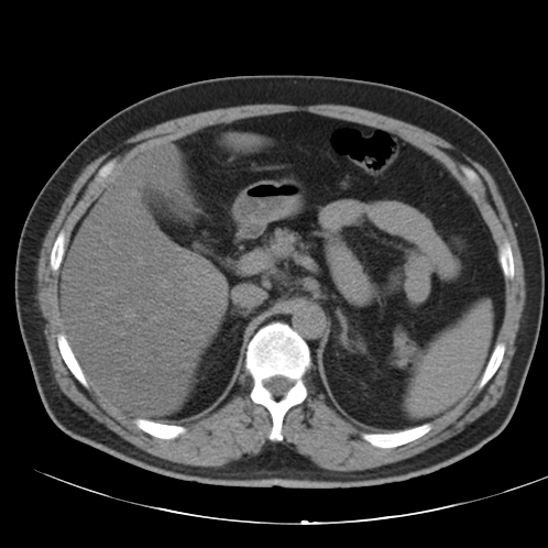 Appendicitis and giant appendicolith (Radiopaedia 80251-93588 Axial non-contrast 12).jpg