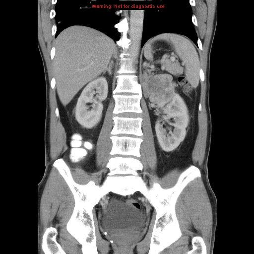 File:Appendicitis and renal cell carcinoma (Radiopaedia 17063-16760 B 20).jpg