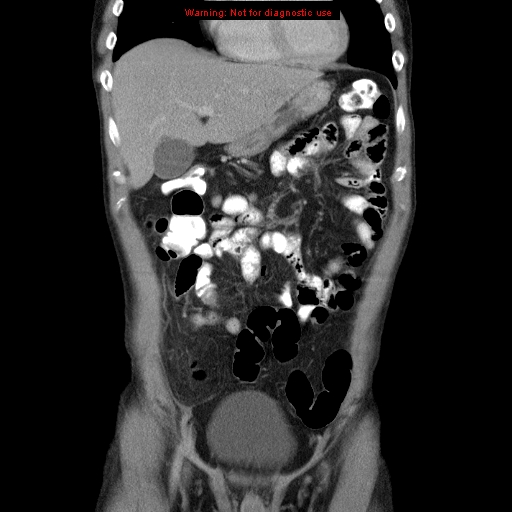 File:Appendicitis and renal cell carcinoma (Radiopaedia 17063-16760 B 9).jpg