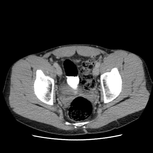 File:Appendicitis complicated by post-operative collection (Radiopaedia 35595-37113 A 70).jpg