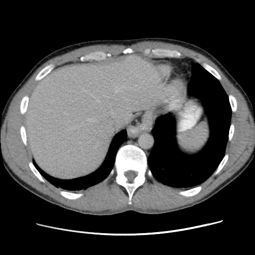 File:Appendicitis complicated by post-operative collection (Radiopaedia 35595-37114 A 14).jpg
