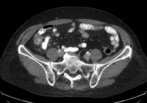 Appendicitis due to chicken fibula (Radiopaedia 74314-85198 A 19).jpg