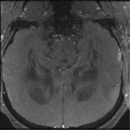 Aqueduct stenosis with corpus callosum hypoattenuation post shunting (Radiopaedia 37212-38969 Axial CSF Flow 41).png