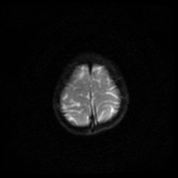 File:Arachnoid cyst - middle cranial fossa (Radiopaedia 86780-102938 Axial DWI 32).jpg