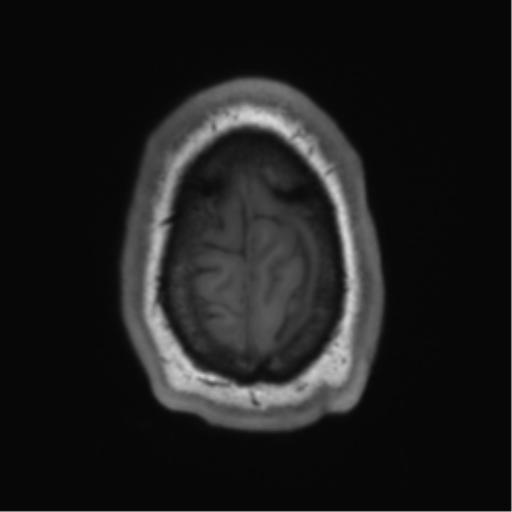 File:Arachnoid cyst with subdural hematoma (Radiopaedia 85892-101743 Axial T1 78).png