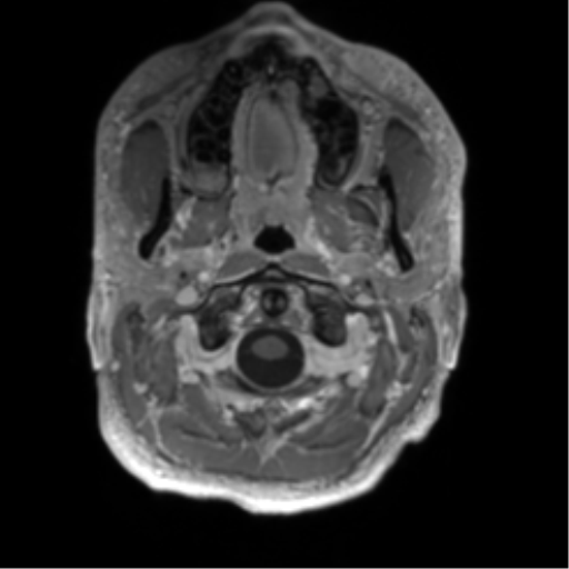 File:Arachnoid cyst with subdural hematoma (Radiopaedia 85892-101743 Axial T1 C+ 5).png