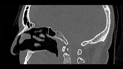 File:Arcuate foramen (Radiopaedia 89833-106944 Sagittal bone window 48).jpg