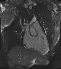 File:Arrhythmogenic right ventricular cardiomyopathy (Radiopaedia 57972-64966 CINE R2 SSFP 27).jpg
