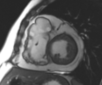 File:Arrhythmogenic right ventricular cardiomyopathy (Radiopaedia 69431-79307 Short axis cine 127).jpg