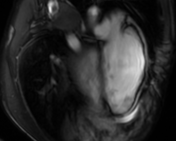 Arrhythmogenic right ventricular cardiomyopathy (Radiopaedia 69564-79464 4ch cine 139).jpg