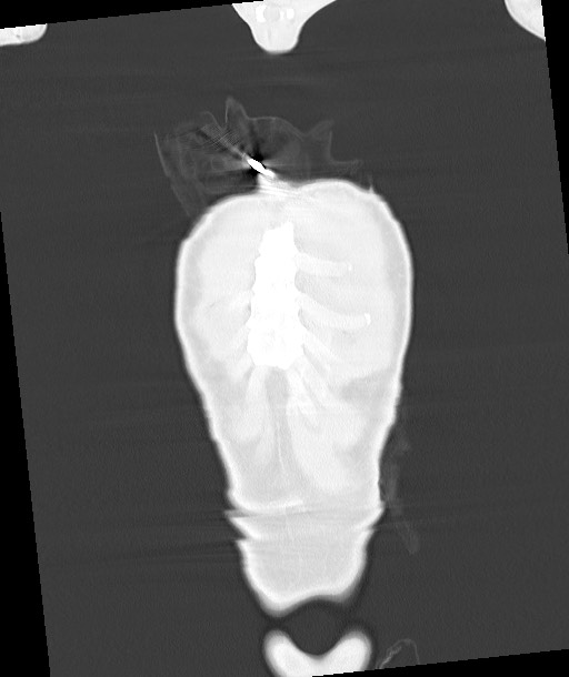 Arrow injury to the chest (Radiopaedia 85367-100975 Coronal lung window 36).jpg