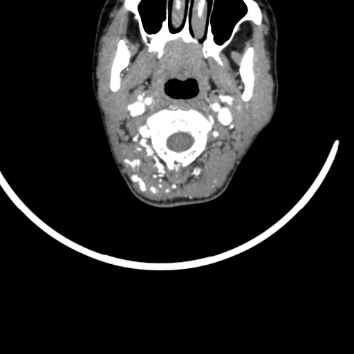 Arteriovenous malformation of the neck (Radiopaedia 53935-60062 A 51).jpg