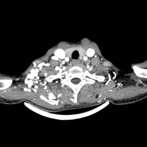 Arteriovenous malformation of the neck (Radiopaedia 53935-60062 A 8).jpg
