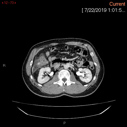File:Ascending colonic diverticulum mimicking acute appendicitis (Radiopaedia 69943-80198 A 73).jpg