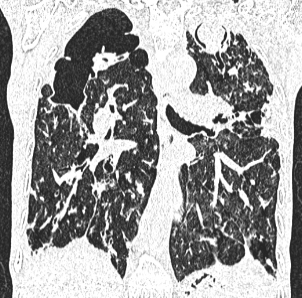 Aspergilloma- with Monod sign (Radiopaedia 44737-48532 Coronal lung window 274).jpg