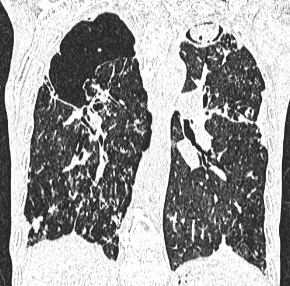 Aspergilloma- with Monod sign (Radiopaedia 44737-48532 Coronal lung window 291).jpg