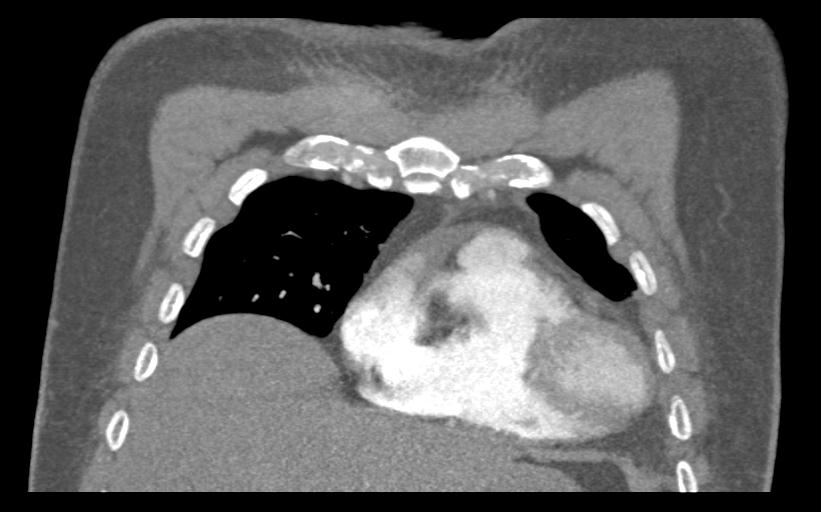 Aspirated tooth (Radiopaedia 28584-28844 Coronal C+ CTPA 19).jpg