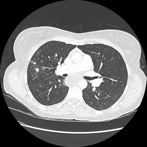 File:Aspiration pneumonia secondary to laparoscopic banding (Radiopaedia 18345-18183 lung window 48).jpg