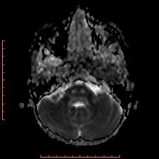 File:Astroblastoma (Radiopaedia 74287-85162 Axial ADC 12).jpg
