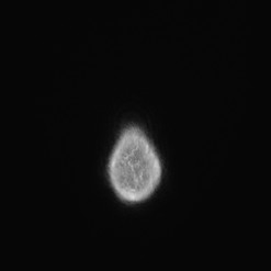 Astrocytoma (Radiopaedia 85660-101440 I 162).jpg