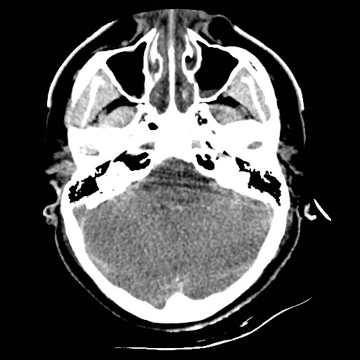Atlanto-occipital dislocation (Radiopaedia 44648-48412 Axial non-contrast 15).jpg