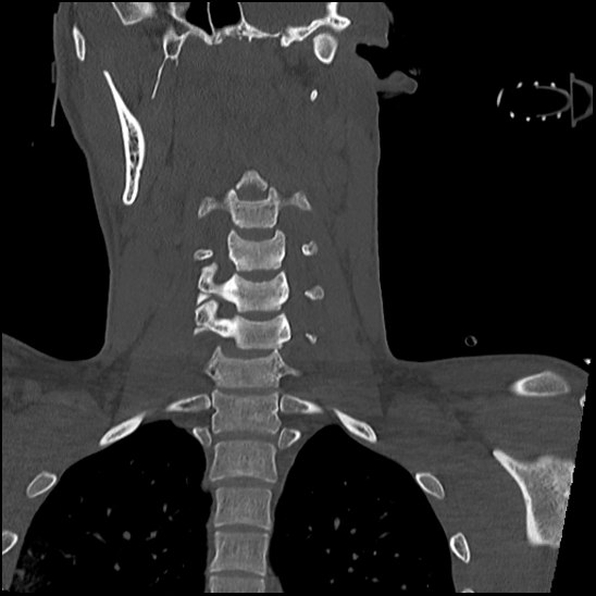 Atlanto-occipital dissociation (Traynelis type 1), C2 teardrop fracture, C6-7 facet joint dislocation (Radiopaedia 87655-104061 Coronal bone window 36).jpg