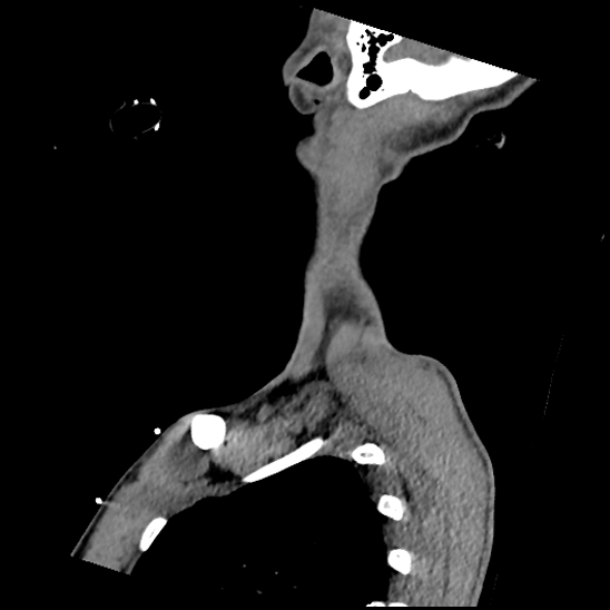 Atlanto-occipital dissociation (Traynelis type 1), C2 teardrop fracture, C6-7 facet joint dislocation (Radiopaedia 87655-104061 D 76).jpg