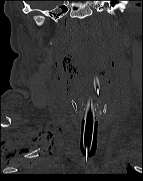 Atlanto-occipital dissociation - Traynelis type 1 (Radiopaedia 87570-103948 Coronal bone window 22).jpg