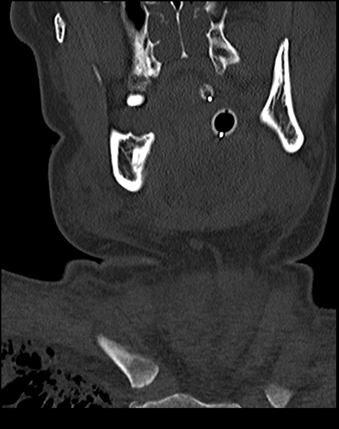 Atlanto-occipital dissociation - Traynelis type 1 (Radiopaedia 87570-103948 Coronal bone window 4).jpg