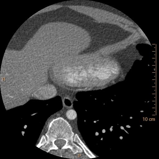 Atrial septal defect (upper sinus venosus type) with partial anomalous pulmonary venous return into superior vena cava (Radiopaedia 73228-83961 A 243).jpg