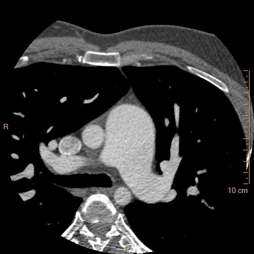 Atrial septal defect (upper sinus venosus type) with partial anomalous pulmonary venous return into superior vena cava (Radiopaedia 73228-83961 A 42).jpg