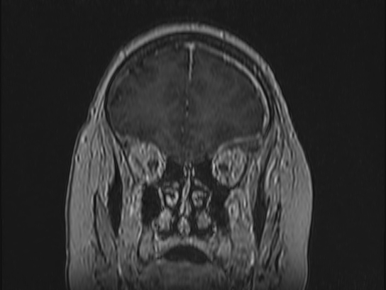 Atypical meningioma (Radiopaedia 62985-71406 Coronal T1 C+ 24).jpg