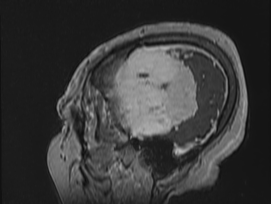Atypical meningioma (Radiopaedia 62985-71406 Sagittal T1 C+ 87).jpg