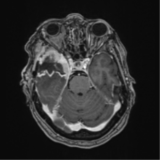 Atypical meningioma (WHO Grade II) (Radiopaedia 54742-60981 Axial T1 C+ 22).png