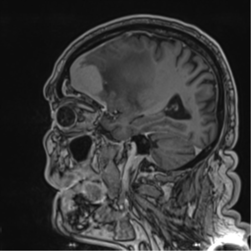 File:Atypical meningioma (WHO grade II) with brain invasion (Radiopaedia 57767-64729 Sagittal T1 C+ 46).png