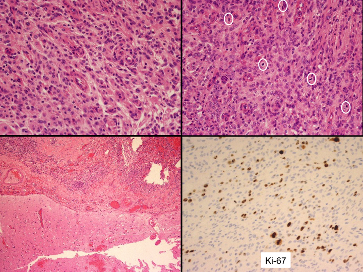 File:Atypical meningioma with skull invasion (Radiopaedia 34357-35748 A 1).png