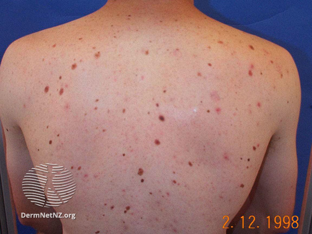 File:Atypical naevi (DermNet NZ lesions-atypical-naevi-609).jpg