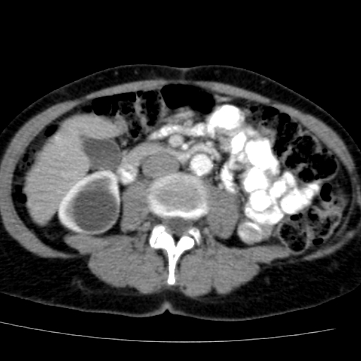 File:Atypical renal cyst (Radiopaedia 17536-17251 renal cortical phase 24).jpg