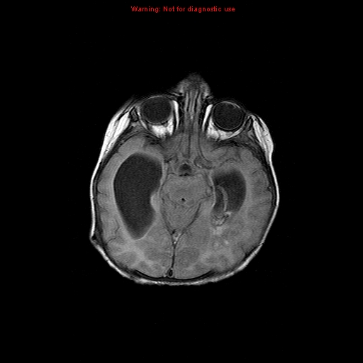File:Atypical teratoid rhabdoid tumor (Radiopaedia 10712-11183 Axial FLAIR 11).jpg