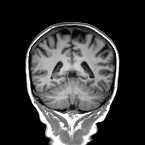 Autoimmune limbic encephalitis (Radiopaedia 30363-31005 Coronal T1 20).jpg