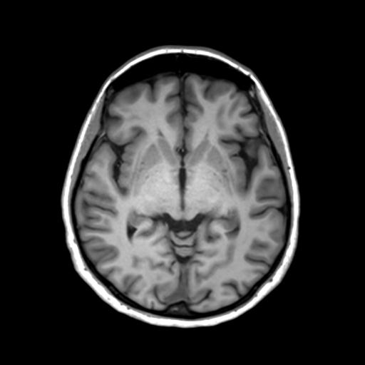Autoimmune limbic encephalitis (Radiopaedia 30363-31005 T1 Axial 3mm 24).jpg