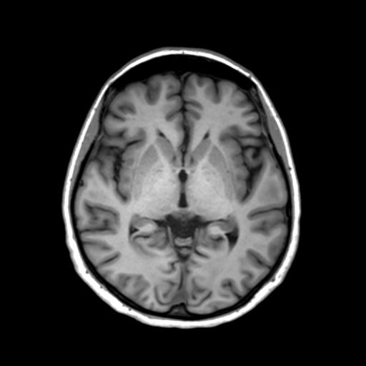 Autoimmune limbic encephalitis (Radiopaedia 30363-31005 T1 Axial 3mm 25).jpg