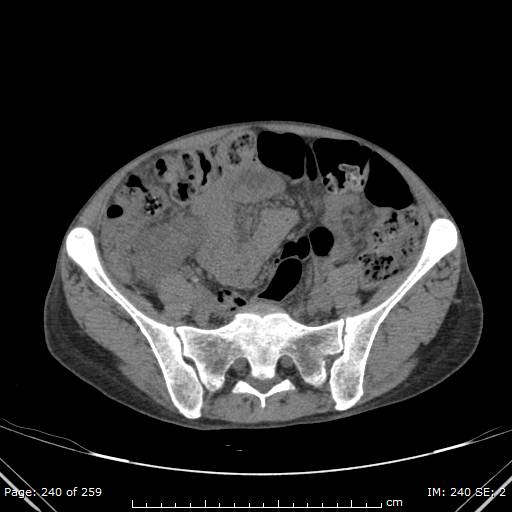 File:Autosomal dominant polycystic kidney disease (Radiopaedia 44122-47684 Axial 78).jpg