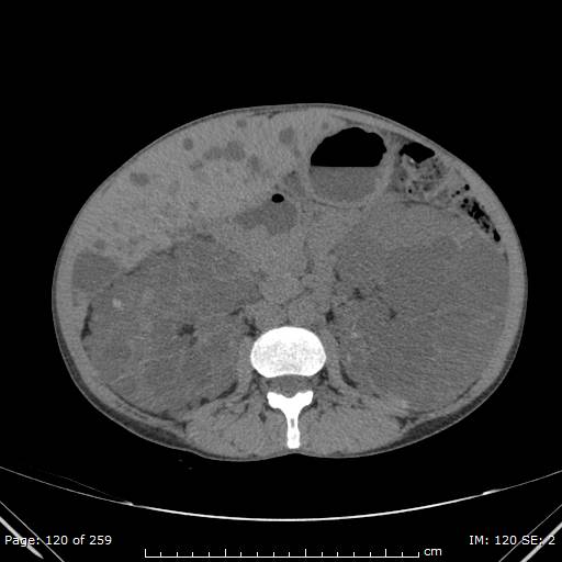 File:Autosomal dominant polycystic kidney disease (Radiopaedia 44122-47684 Axial 9).jpg