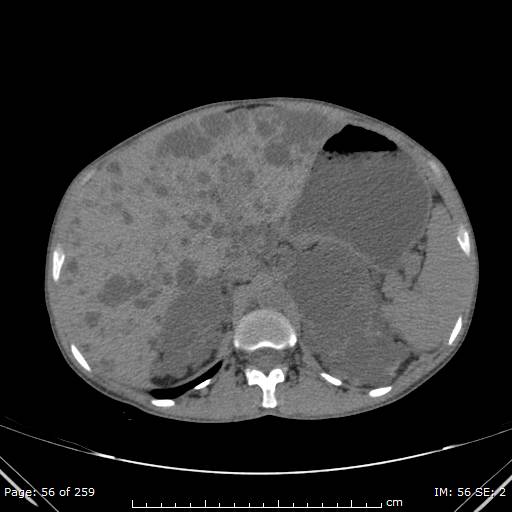 Autosomal dominant polycystic kidney disease (Radiopaedia 44122-47684 Axial non-contrast 20).jpg