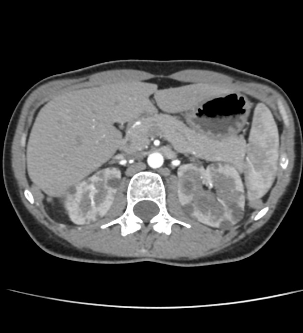 Autosomal dominant polycystic kidney disease - early onset (Radiopaedia 40734-43387 B 13).jpg